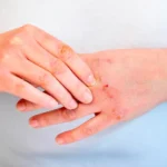Dermatite e stress: ecco come riconoscere se la tua pelle sta soffrendo per l’ansia